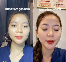 🔥🔥🔥 𝐓𝐈𝐄̂𝐌 𝐁𝐎𝐓𝐎𝐗 𝐓𝐇𝐎𝐍 𝐆𝐎̣𝐍 𝐇𝐀̀𝐌 #Botox Vip siêu mạnh  ➡tạm biệt gương mặt góc cạnh ➡lấy lại gương mặt thon gọn vline ⛔️⛔️ 𝘊𝘰̛  𝘩𝘢̀𝘮 𝘵𝘰 𝘣𝘢̂̉𝘮 𝘴𝘪𝘯𝘩 , 𝘩𝘰𝘢̣̆𝘤 𝘱𝘩𝘢́𝘵