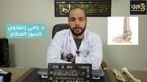 أنواع كسور العظام وكيفية علاجها Youtube