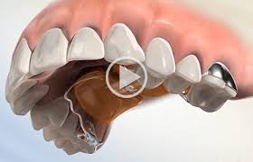 Chewing forces actually increase the effectiveness of palate expanders. Orthodontic Appliances Southern Maine Orthodontics In Scarborough Me