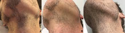 Cortisone shots are given for an inflammatory response which causes hair to eject (ie. Cureus Successful Treatment Of Alopecia Areata Barbae With Platelet Rich Plasma