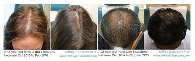 It's especially common after reaching age 50 or as a. Las Vegas Dermatology Platelet Rich Plasma Prp For Hair Loss And Anti Aging