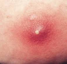 When one develops a cyst where there is an ingrown hair it definitely means that the infection is deep into the skin. Ingrown Hair Cyst Removal How To Get Rid Pop Treat Deep Infected Pubic Follicles Pictures Healthrave