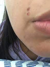 Do this three to four times daily until the pimple releases pus and heals. After Waxing Pimples To Bruises Beautylish