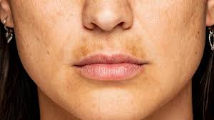 Image result for Melasma