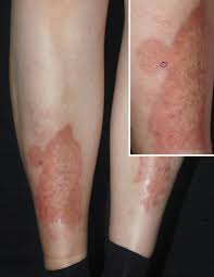 Image result for liver spots on legs