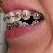 Braces Girlswithbraces Metalbraces Powerchain Braces Colors Braces Tips Metal Braces