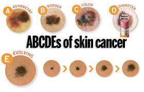 Common types of skin cancer include: The Three Types Of Skin Cancer And How To Prevent Them By Tim Ioannides Md Medium