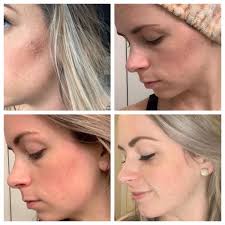 How to get rid of pregnancy acne?