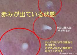 カソーダ 赤み ひりひり 感肌荒れ 写真 肌荒れ ニキビ ほくろ除去クリーム 肌 赤み