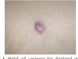 Mcc was first described in 1972 and only in the 1990s was the ck20 antibody developed to make it easily identifiable by pathologists. Pdf A Case Of Merkel Cell Carcinoma Development Under Treatment With A Janus Kinase Inhibitor Semantic Scholar