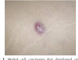 Two case reports focusing on the role of fluorodeoxyglucose positron reliability of sentinel lymph node biopsy for regional staging of head and neck merkel cell carcinoma. Pdf A Case Of Merkel Cell Carcinoma Development Under Treatment With A Janus Kinase Inhibitor Semantic Scholar