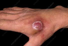 Image result for Pyogenic Granuloma