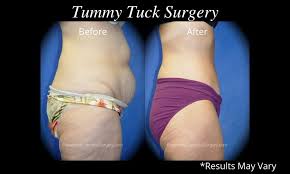 Depending on your desired results, this surgery can take anywhere from one to five hours. What Can A Tummy Tuck Address What Can It Not Pasadena Cosmetic Surgery