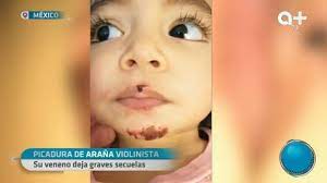 Descubre qué hacer si te pica una araña del rincón. La Mordedura De Una Arana Violinista Deja Graves Secuelas