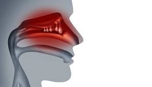 Be it the steroid therapy that. Nasal Polyps Oc Ent Clinic Sinus Surgery Septoplasty Tonsillectomy Ent Doctor