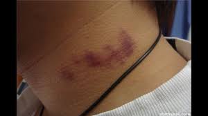 Oct 08, 2014 · i can make people do things (4.34) but took a long time for it to do me, or the world any good. How To Make A Hickey Go Away In 5 Minutes Youtube