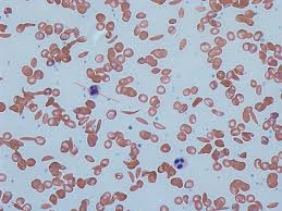 Who gets sickle cell anemia? Sickle Cell Trait Wikipedia