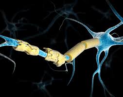 Some will have partial losses, others will have complete loss of sensation and function. Transverse Myelitis