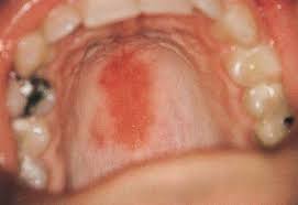 Image result for Physical injury red spots roof of mouth