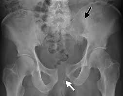 Check spelling or type a new query. Pelvic Ring Fractures What The Orthopedic Surgeon Wants To Know Radiographics