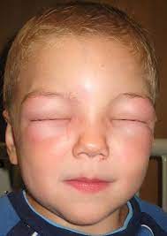 File Angioedema2010 Jpg Wikipedia The Free Encyclopedia Anaphylaxis Allergy Symptoms Allergic Reaction Remedies