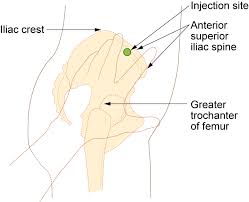 Image result for Intramuscular Injection