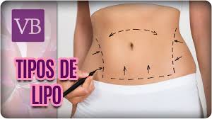 If you're overweight, you're likely to lose more weight through diet and exercise or through bariatric procedures — such as gastric bypass surgery — than you would with liposuction. Lipoaspiracao Lipoescultura E Lipoenxertia Voce Bonita 31 08 17 Youtube