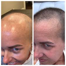 One month of hair growth! 😍 I was devastated to lose my hair, but to be  honest I never felt so empowered then when I was rocking the bald head!  From chia