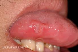 Syphilis is a highly contagious disease spread primarily by sexual activity. Fruhsyphilis Altmeyers Enzyklopadie Fachbereich Dermatologie
