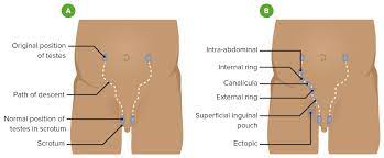 This article explores the causes of cryptorchidism, risk. Cryptorchidism Concise Medical Knowledge