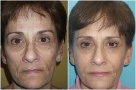 voluma, Cosmetic Dermatology by Wendy Epstein, M.D., F.A.A.D. NYACK, NY  Before and After Gallery