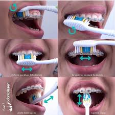 Dentistry World Dentistry World V Instagram Repost Odontolasergroup We Want To Share With All The People Who Hav Braces Colors Teeth Braces Braces Tips