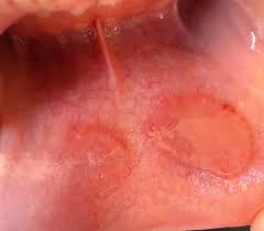 Image result for Labial mucosa