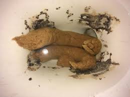 Image result for thin ribbon stools human poop