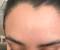 Tiny Bumps On Face Allergic Reaction