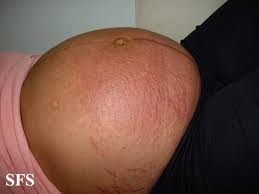 Image result for pruritic urticarial papules and plaques of pregnancy