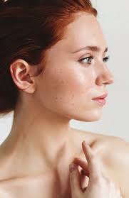 CHRONIC SKIN CONDITIONS