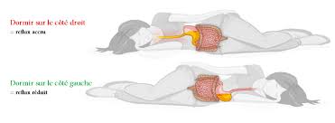 On parle de remontées acides lorsqu'une partie du contenu de l'estomac remonte dans l'œsophage et parfois jusque dans la. Le Rgo Vous Empeche T Il De Dormir Societe Gastro Intestinale Www Mauxdeventre Org