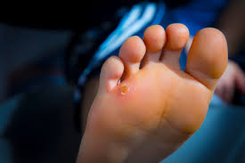 The best way to prevent foot injuries and uncomfortable issues, such as blisters, is to ensure you have the right footwear for your activities. Why Do Corns Calluses Keep Coming Back Clark Nj Foot Doctor