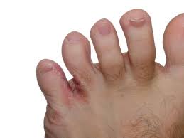The fungus between the toes is widecommon disease. What Is Athlete S Foot Comforting Footwear