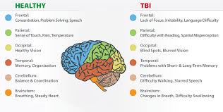 What are the symptoms and signs of a concussion? Conditions Concussion Traumatic Brain Injuries Tbi Neurospa Brain Rejuvenation Center