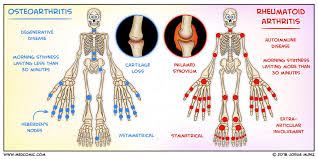 Osteoarthritis Vs Rheumatoid Arthritis Medcomic Rheumatoid Arthritis Osteoarthritis Vs Rheumatoid Arthritis Orthopedic Nursing