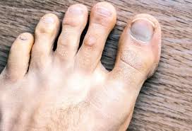 Image result for Pitting nails feet