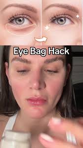 Natural Remedies to Eliminate Eye Bags Effectively