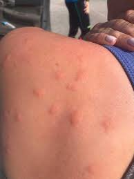 Itching can be helped with topical corticosteroids and antihistamines as well as hot showers or baths. Minute Pirate Bugs The Tiny Pest With A Big Bite