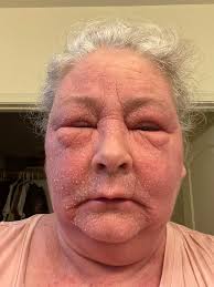 Support and Prayers for Chronic Skin Disease and Missing Mother