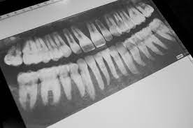 Additionally, they can help to avoid the financial costs associated with large treatment plans later on. Learn All About Teeth With Dental X Rays For Your Light Table