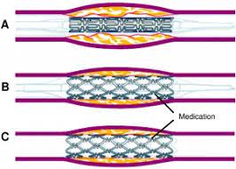 Coronarografie cu sau fara implantare stent indicatii riscuri pret video cabinet cardiologie deva dr benteu darius. Despre Stentul Farmacologic Activ Cabinet Cardiologie Deva Dr Benteu Darius