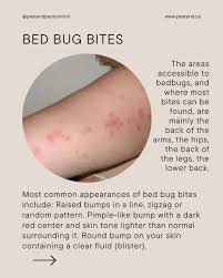Image result for bedbugs bites