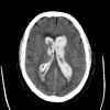 Le emorragie cerebrali sono particolarmente frequenti nei nati prematuri. Https Encrypted Tbn0 Gstatic Com Images Q Tbn And9gcr6ga09awxc Vpnv50 7ldsojfh1vso5eehr3mpi8mlvhcu7g3n Usqp Cau